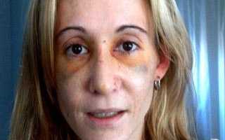 Реабилитация после ринопластики: как избежать негативных последствий