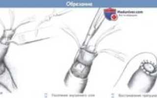 Мучает ночная эрекция после обрезания