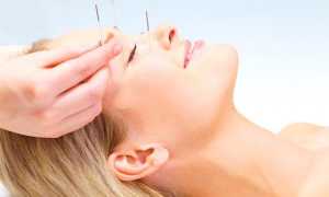 Акупунктурный лифтинг лица: иглоукалывание как альтернатива ботоксу