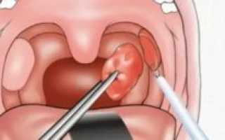 Температура после удаления миндалин