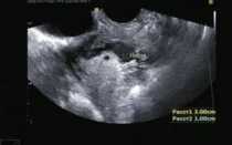 Возможно ли, что плодное яйцо не опустилось в матку?