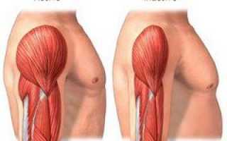 Атрофия мышц