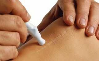 Стрии у сильного пола