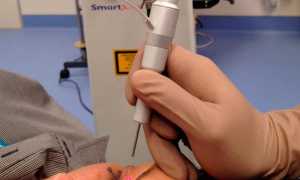 Эффект от лазерной блефаропластики век и секреты быстрого заживления после неё