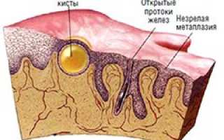 Наботовы кисты