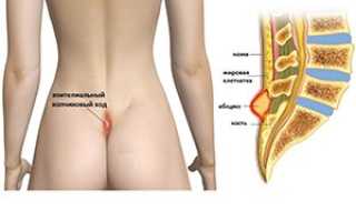 Эпителиальный копчиковый ход