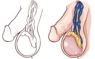 О последствиях варикоцеле: насколько это страшно?