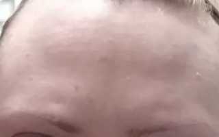 Вертикальные впадины на лбу, что это может быть?