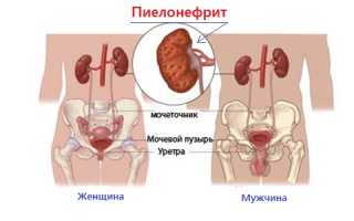 Основные понятия пиелонефрита почек