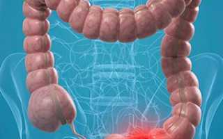 Дивертикулез сигмовидной кишки