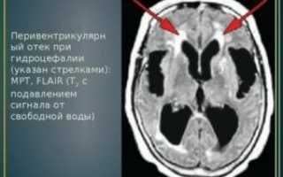 Перивентрикулярный отек