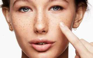 Какой пилинг от пигментных пятен и веснушек наиболее эффективен