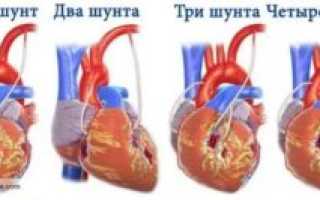 Можно ли после шунтирования сердца работать водителем?