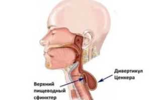 Ощущение застрявшей таблетки в горле