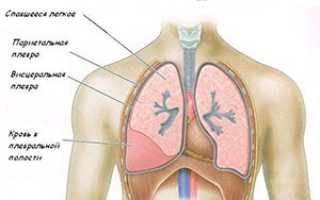 Гемоторакс