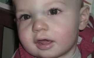 Синяя переносица у ребенка