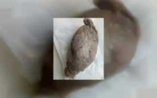 Забытый тампон больше суток