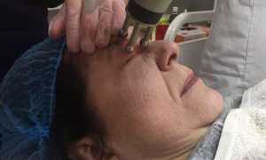 Лазерная шлифовка век: важные особенности антивозрастной процедуры