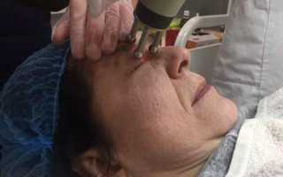 Лазерная шлифовка век: важные особенности антивозрастной процедуры