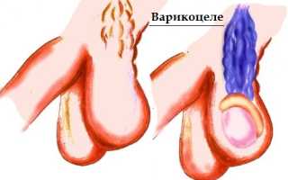 Особенности варикоцеле на второй стадии его развития