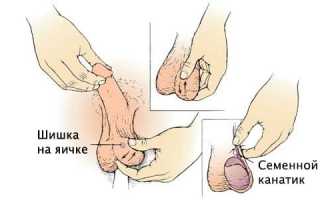 О каких заболеваниях может свидетельствовать появление шишки на яичках