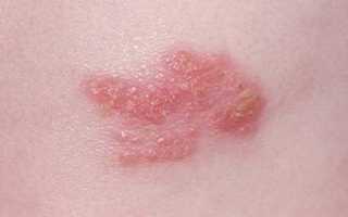 Опоясывающий лишай