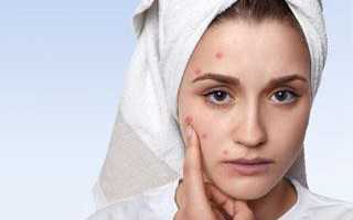 Чистка лица от прыщей в домашних условиях и в салоне: все, что важно знать о процедуре