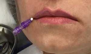 Лифтинг губ нитями или филлерами: что выбрать