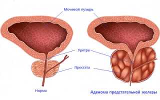 Как бороться с аденомой простаты?