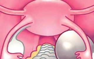 Функциональная киста