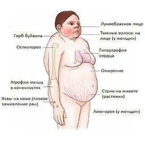 Симптомы болезни Иценко — Кушинга