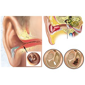 Экссудативный отит