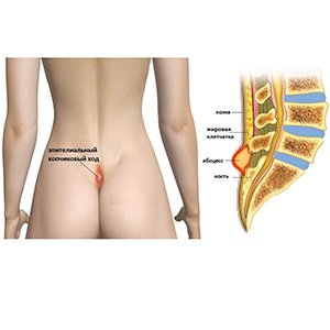 Эпителиальный копчиковый ход