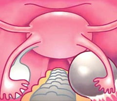 Функциональная киста