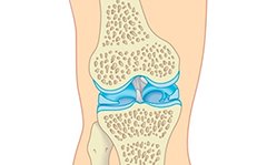 Хондрокальциноз