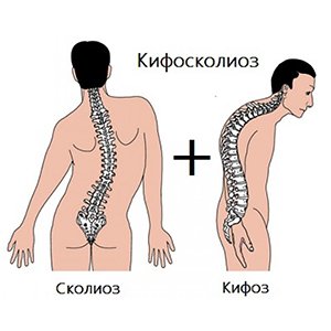 Кифосколиоз
