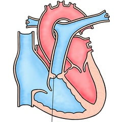 Стеноз легочной артерии