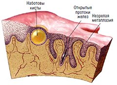 Наботовы кисты