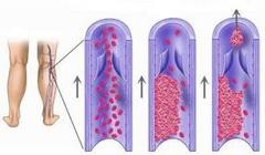 Тромбоз нижней полой вены