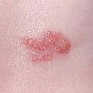 Опоясывающий лишай