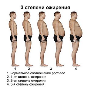 Степени ожирения