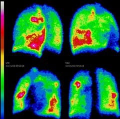 Результаты сцинтиграфии легких Результаты сцинтиграфии легких