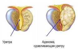 Adenoma prostaty