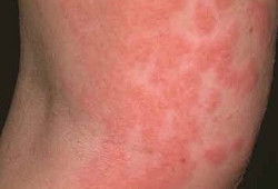 Дерматит у мужчин Dermatit u muzhchin