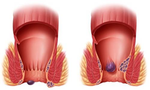 Геморрой наружный и внутренний Gemorroj naruzhnyj i vnutrennij