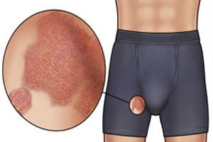 Паховый грибок у мужчин Паховый грибок у мужчин