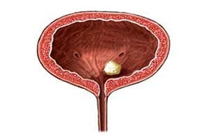 Камни в мочевом пузыре