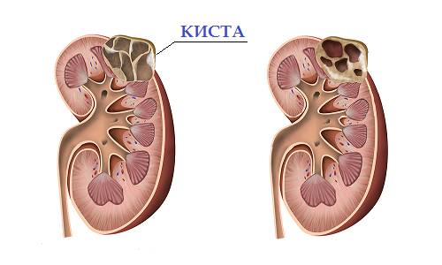 Киста почек Kista