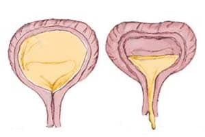 Нейрогенный мочевой пузырь