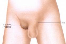 Паховая грыжа Pahovaja gryzha